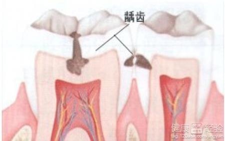 什麼情況下可以考慮把齲齒拔掉呢