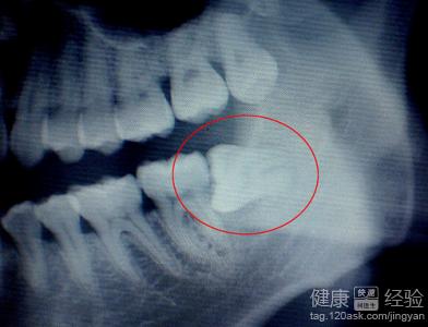 治療齲齒冠周炎最佳方法是什麼