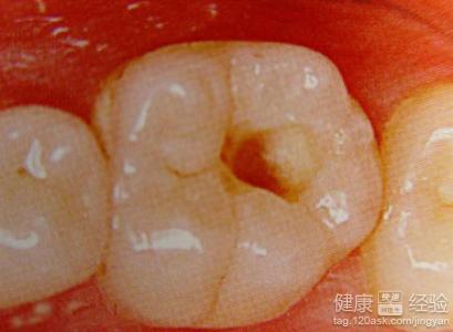 齲齒導致的牙髓炎做體開髓引流治療可以嗎
