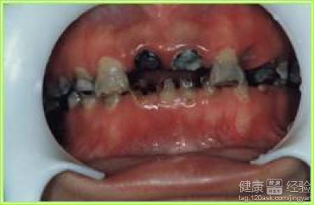 孩子的乳牙得了齲齒但不疼還用治療嗎？