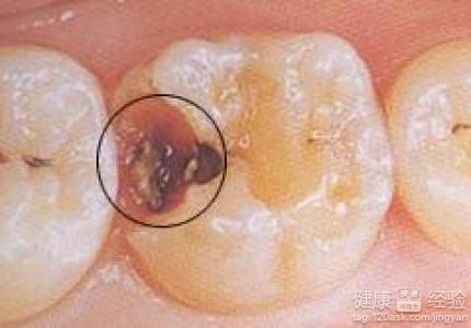 如何預防牙齒發生齲壞