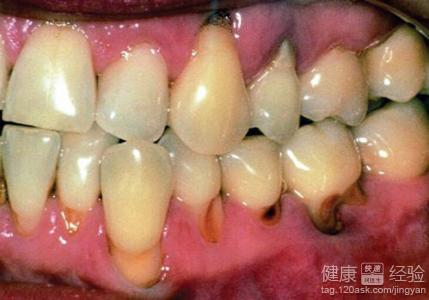生活中如何預防齲齒的出現？