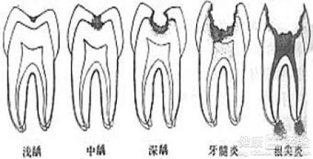 齲齒的臨床症狀及治療