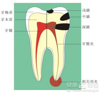 如果得了齲齒怎麼辦