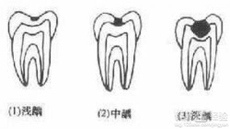 齲病怎麼辦