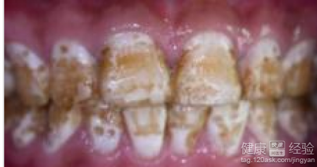 冷光美白可以治療氟斑牙嗎
