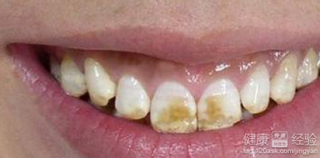 氟斑牙和水質有關系嗎