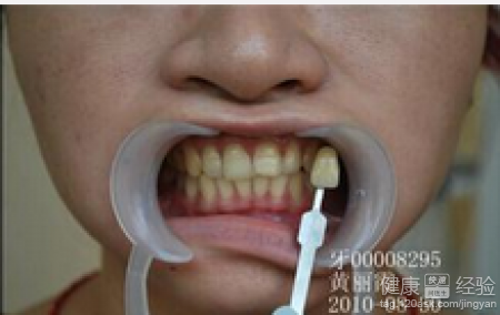 怎樣判斷是否是氟斑牙