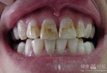 長有氟斑牙的危害大嗎