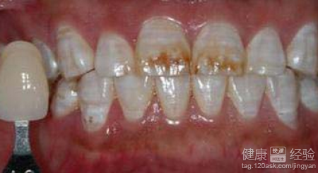 氟斑牙美白後會復發嗎
