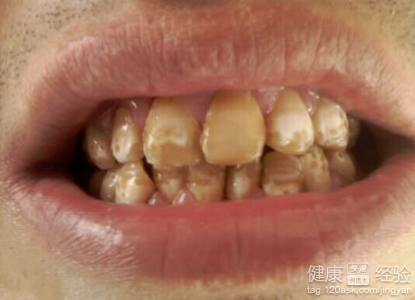 氟斑牙產生的程度具體有什麼