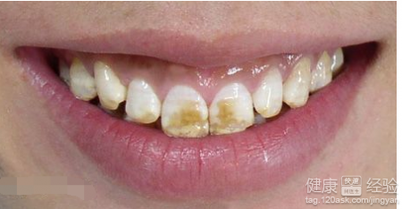 氟斑牙具體危害表現有哪些