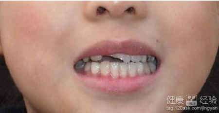 什麼方法治療牙齒修復