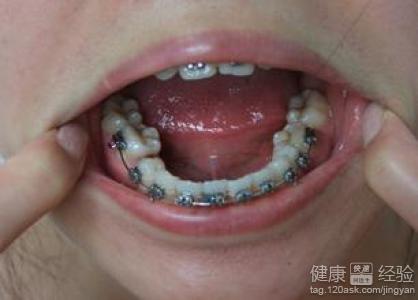 牙齒矯正手術一般要多久