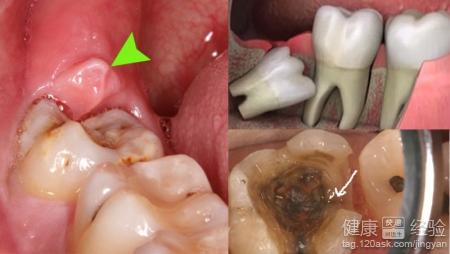 智齒疼怎麼辦