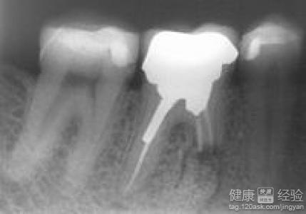 根管治療後牙齒壽命