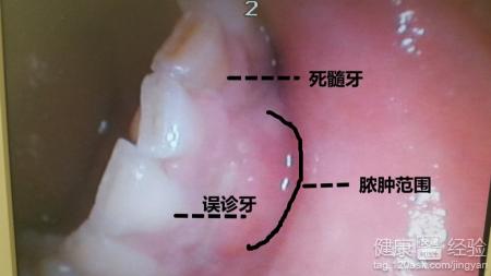 牙根疼怎麼辦