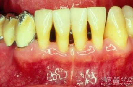牙結石怎麼清除