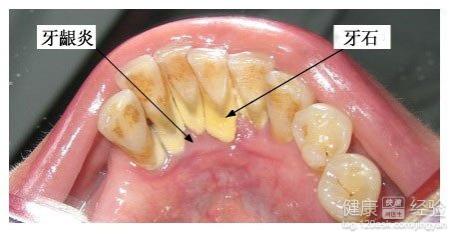 牙結石的治療方法