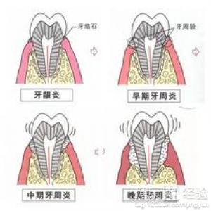 牙龈腫痛怎麼快速消腫