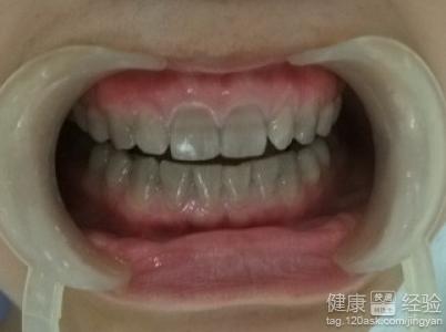 四環素牙的治療方法