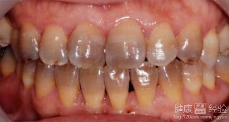 四環素牙能變白嗎