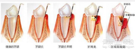 牙菌斑中醫治療診斷方法