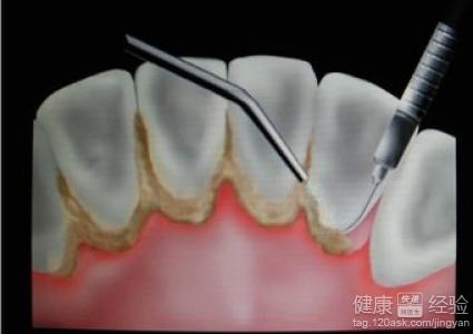 牙菌斑對牙齒有哪些危害