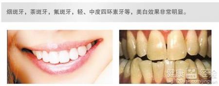 牙齒美白的最好方法