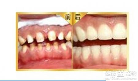 牙齒美容的修復方法有哪些