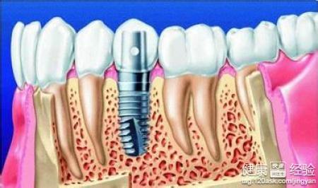 種植牙後的並發症