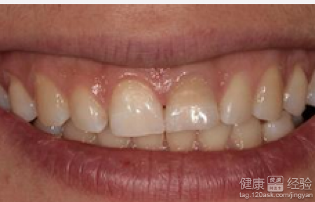 骨性前突牙齒矯正過程