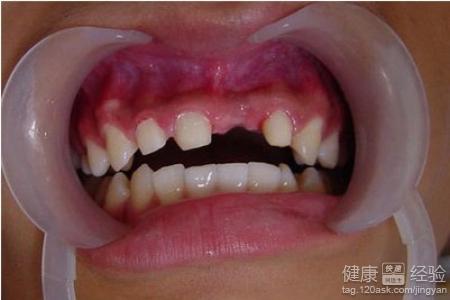 牙齒缺失後對生活有什麼影響