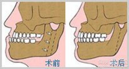 韓式外科正牙與正颌外科手術的區別是什麼