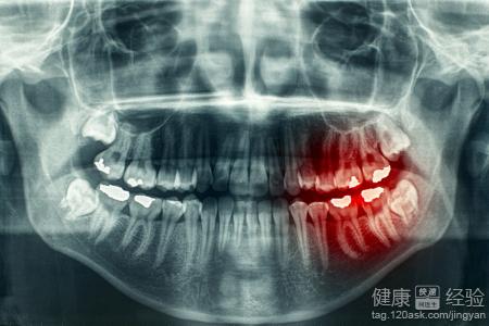 牙齒缺損怎麼修復
