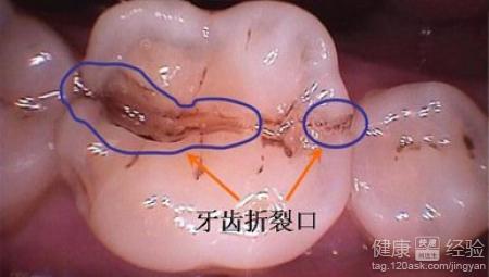 牙齒裂開修復要多少錢