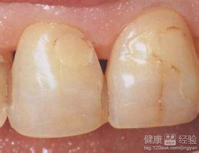 牙齒有裂紋如何修復