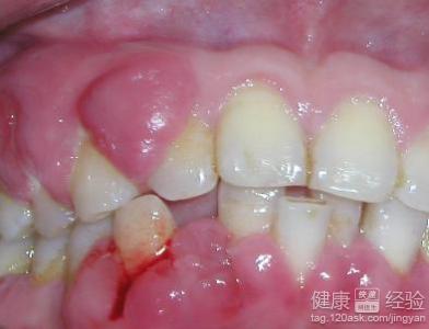 有牙周炎可以做牙齒矯正嗎