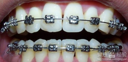 牙齒矯正的材料國產和進口有什麼區別