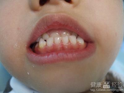 孩子牙齒反合還有治療希望嗎