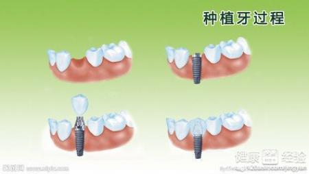 如何治療種植牙齒