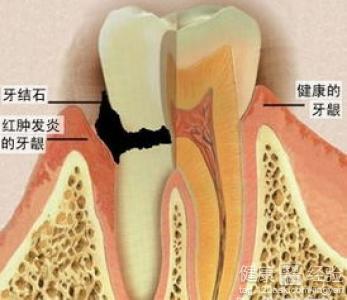 牙周炎的預防以及治療