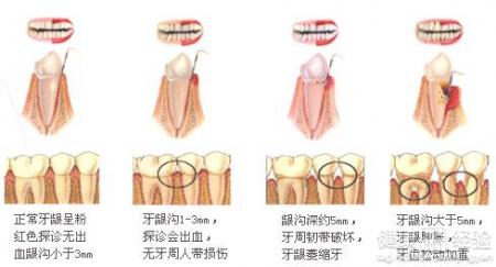 牙周炎應怎樣治療和保養