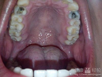 口腔裡有顆牙齒痛該如何治療