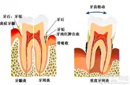 牙周炎如何用藥