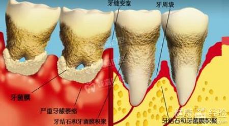 怎樣減輕牙周炎引導致的牙疼