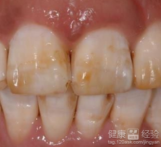 四環素牙怎麼能美白可以達到最好的效果呢