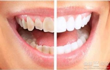 四環素牙會引起牙釉質腐蝕的可能嗎