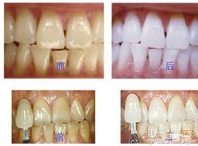 有四環素牙想整牙變白該怎麼做呢