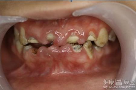 牙齒破損是否有影響